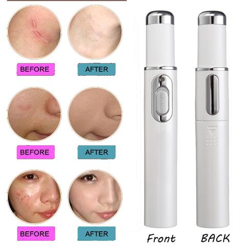 Revitalize Your Skin with the Blue Light Therapy Acne Laser Pen – Effective Soft Scar & Wrinkle Removal Treatment