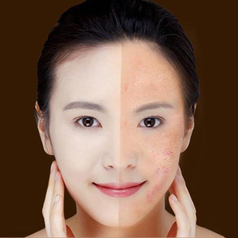 Revitalize Your Skin with the Blue Light Therapy Acne Laser Pen – Effective Soft Scar & Wrinkle Removal Treatment